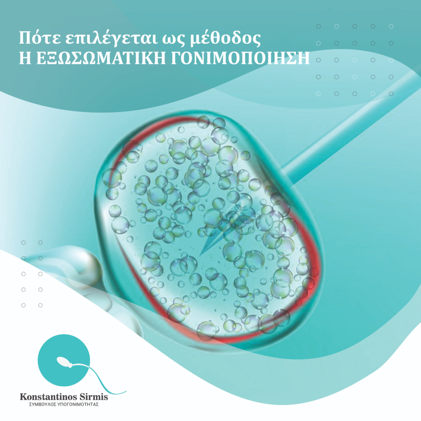 ⯑ Πότε επιλέγεται ως μέθοδος η εξωσωματική γονιμοποίηση;